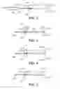 Fig. 03 - Methods and Devices for Controlling the Size of Emphysematous Bullae