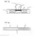 Fig. 11 - METHODS AND DEVICES FOR TREATMENT OF VASCULAR DEFECTS