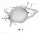 Fig. 03 - Occluder for occluding an atrial appendage and production process therefor