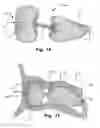 Fig. 11 - Occluder for occluding an atrial appendage and production process therefor