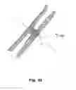 Fig. 17 - Occluder for occluding an atrial appendage and production process therefor