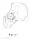 Fig. 25 - Reciprocating rasps for use in an orthopaedic surgical procedure