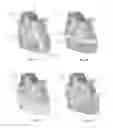Fig. 04 - Pericardial modification systems and methods for heart failure treatment