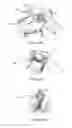Fig. 12 - SUPPORT ELEMENT FOR CIRCUMCISION AND SYSTEM COMPRISING THE SAME