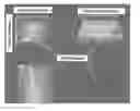 Fig. 01 - Real time three-dimensional heat-induced echo-strain imaging for monitoring high-intensity acoustic ablation produced by conformal interstitial and external directional ultrasound therapy applicators