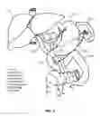 Fig. 03 - Devices and methods for intrahepatic shunts