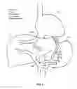 Fig. 04 - Devices and methods for intrahepatic shunts