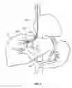 Fig. 07 - Devices and methods for intrahepatic shunts