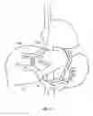Fig. 12 - Devices and methods for intrahepatic shunts