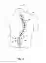 Fig. 04 - Inverted serpentine spinal stability device and associated methods