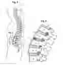 Fig. 02 - Systems and methods for reducing pressure within a spinal disc