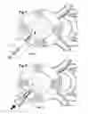 Fig. 05 - Systems and methods for reducing pressure within a spinal disc