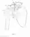 Fig. 10 - CLAVICLE FIXATION