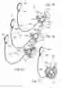 Fig. 07 - ADJUSTABLE TENSION RING FOR AMELIORATION OF URINARY INCONTINENCE IN FEMALES