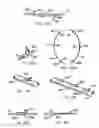 Fig. 64 - ENDOLUMINAL FILTER HAVING ENHANCED ECHOGENIC PROPERTIES
