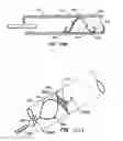 Fig. 72 - ENDOLUMINAL FILTER HAVING ENHANCED ECHOGENIC PROPERTIES