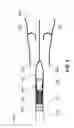 Fig. 06 - Sutureless valve prosthesis delivery device and methods of use thereof