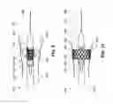 Fig. 07 - Sutureless valve prosthesis delivery device and methods of use thereof