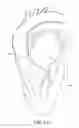 Fig. 02 - Adjustable endolumenal implant for reshaping the mitral valve annulus