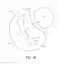 Fig. 03 - Adjustable endolumenal implant for reshaping the mitral valve annulus