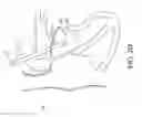 Fig. 07 - Adjustable endolumenal implant for reshaping the mitral valve annulus