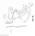 Fig. 08 - Adjustable endolumenal implant for reshaping the mitral valve annulus