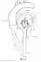 Fig. 10 - Adjustable endolumenal implant for reshaping the mitral valve annulus