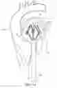 Fig. 11 - Adjustable endolumenal implant for reshaping the mitral valve annulus