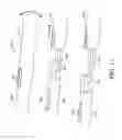 Fig. 30 - Adjustable endolumenal implant for reshaping the mitral valve annulus
