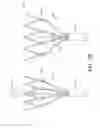 Fig. 41 - Adjustable endolumenal implant for reshaping the mitral valve annulus