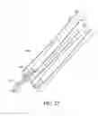Fig. 48 - Adjustable endolumenal implant for reshaping the mitral valve annulus