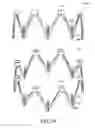 Fig. 50 - Adjustable endolumenal implant for reshaping the mitral valve annulus