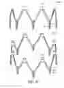 Fig. 51 - Adjustable endolumenal implant for reshaping the mitral valve annulus