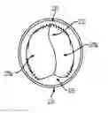 Fig. 01 - Expandable implantable conduit