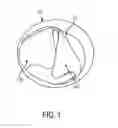 Fig. 02 - Expandable implantable conduit