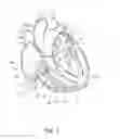 Fig. 02 - Percutaneous valve repair by reshaping and resizing right ventricle