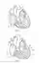 Fig. 03 - Percutaneous valve repair by reshaping and resizing right ventricle