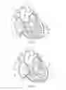 Fig. 05 - Percutaneous valve repair by reshaping and resizing right ventricle