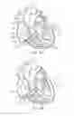 Fig. 07 - Percutaneous valve repair by reshaping and resizing right ventricle