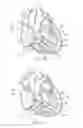 Fig. 08 - Percutaneous valve repair by reshaping and resizing right ventricle