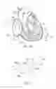 Fig. 09 - Percutaneous valve repair by reshaping and resizing right ventricle