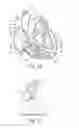 Fig. 10 - Percutaneous valve repair by reshaping and resizing right ventricle