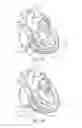 Fig. 12 - Percutaneous valve repair by reshaping and resizing right ventricle