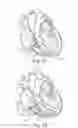 Fig. 13 - Percutaneous valve repair by reshaping and resizing right ventricle