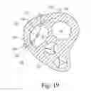 Fig. 14 - Percutaneous valve repair by reshaping and resizing right ventricle