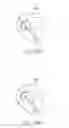 Fig. 15 - Percutaneous valve repair by reshaping and resizing right ventricle