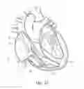 Fig. 16 - Percutaneous valve repair by reshaping and resizing right ventricle