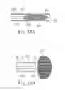Fig. 17 - Percutaneous valve repair by reshaping and resizing right ventricle