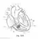 Fig. 19 - Percutaneous valve repair by reshaping and resizing right ventricle
