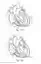 Fig. 20 - Percutaneous valve repair by reshaping and resizing right ventricle